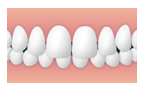 上顎前突(出っ歯)
