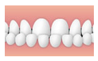 反対咬合(受け口)