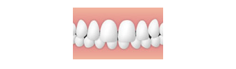上顎前突(出っ歯)