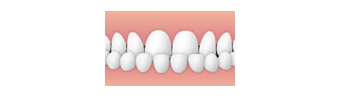 反対咬合(受け口)